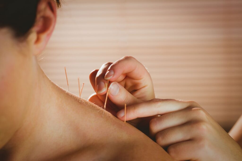 Dry needling